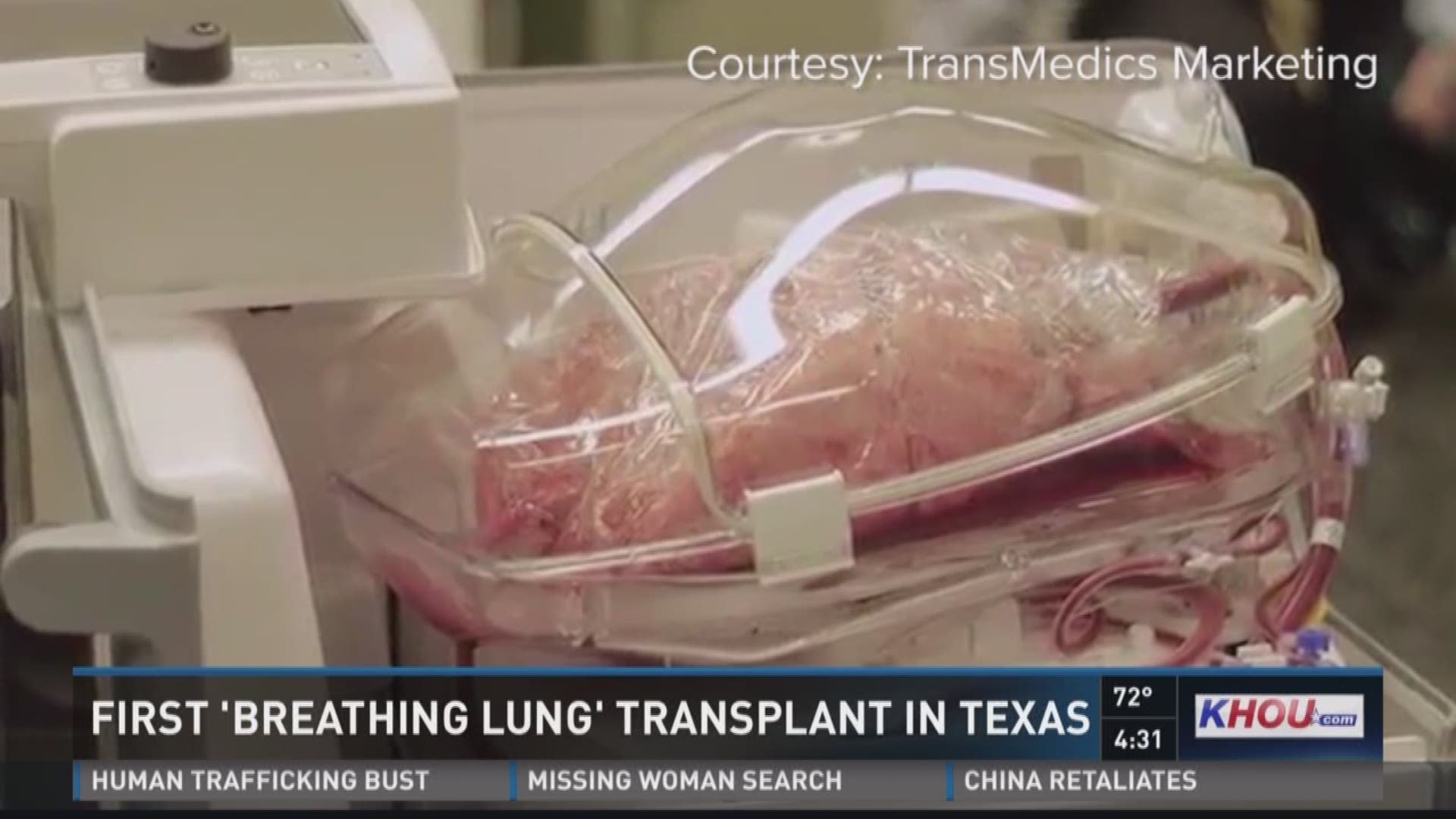 A local hospital has become the first in Texas, and third in the country, to successfully complete a breathing lung transplant. Surgeons at Baylor St. Luke's Medical Center used a device that simulates human-like conditions for the donor lung while in tra