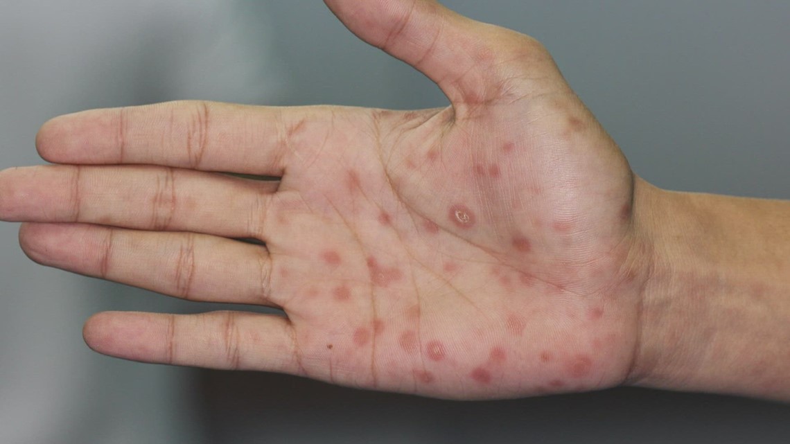 Syphilis cases continue to increase in Texas - Vimarsana News