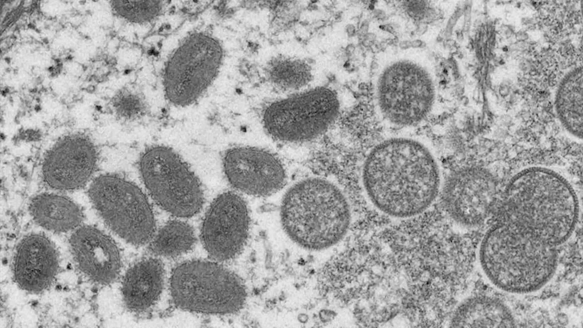 The number of monkeypox cases in Texas is now 20, according to the Department of Health Services.