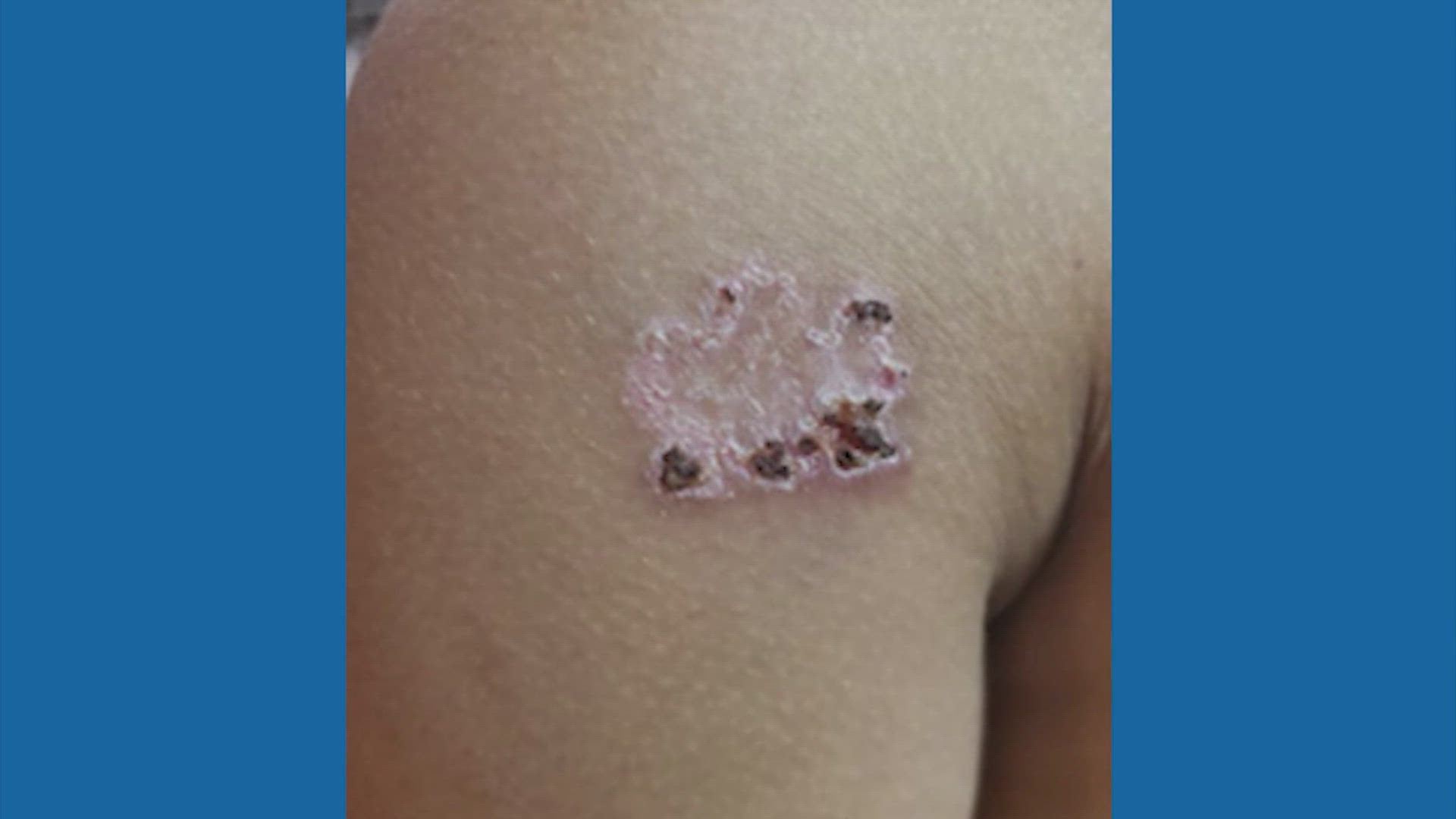 Lawsuit filed after Texas boy branded during religious ceremony