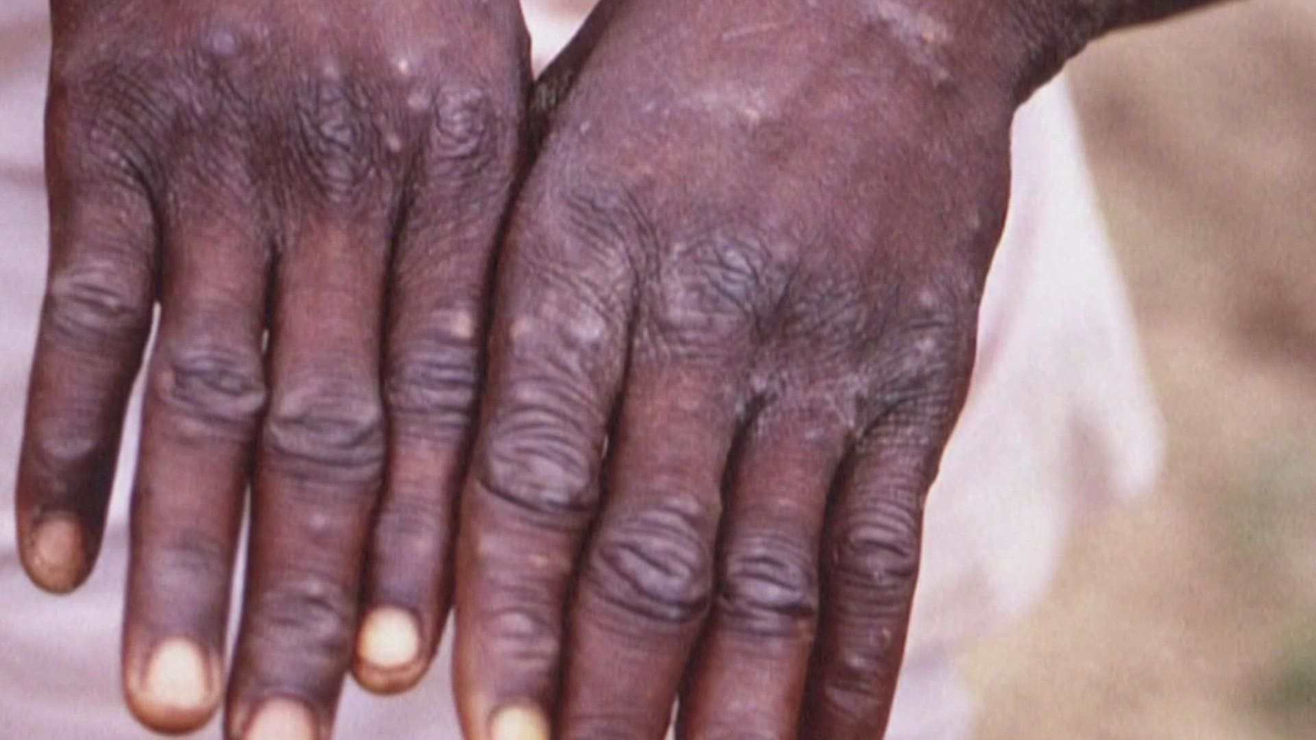 The number of monkeypox cases in Texas has increased to 27. The number of cases in Houston stands at 11 as of July 8, 2022.