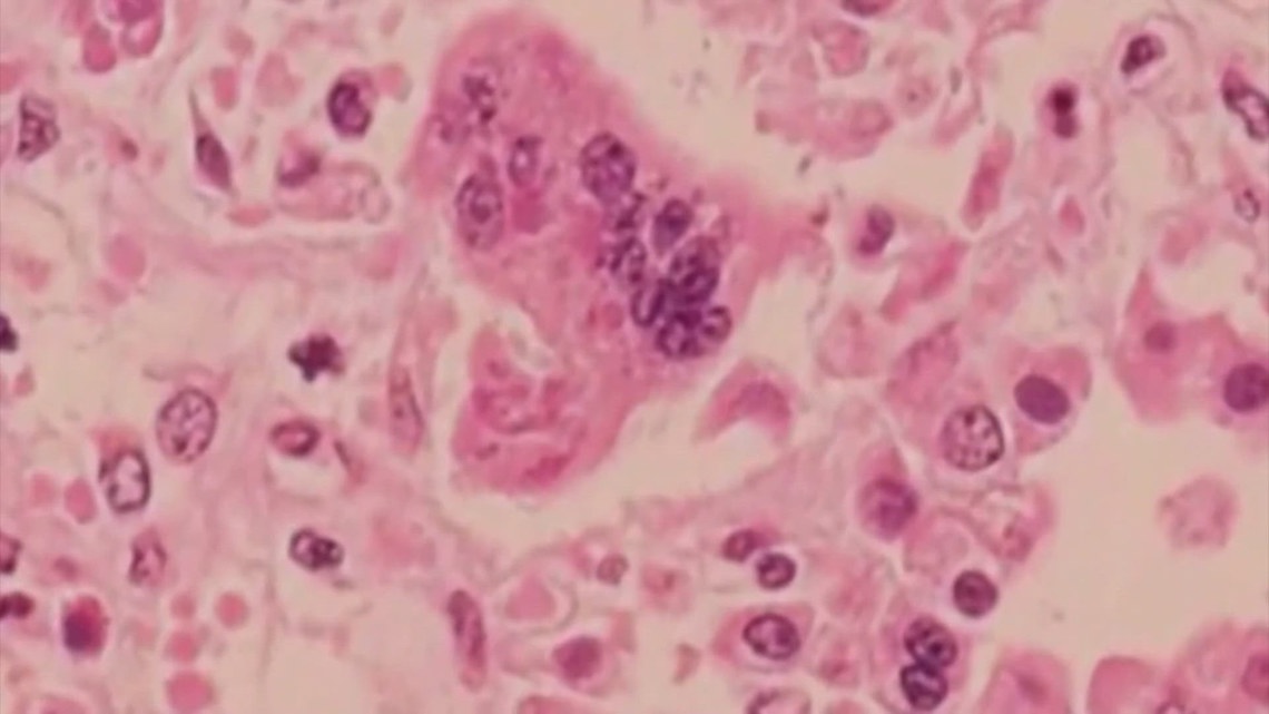Texas measles outbreak: First death reported is unvaccinated child ...